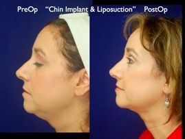 FacLift.007.jpg