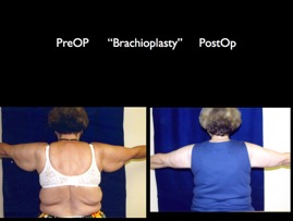 Brach.001.jpg