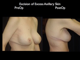 back-axilla.017.jpg