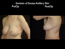 back-axilla.018.jpg