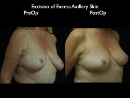 BreastLift2012.024.jpg