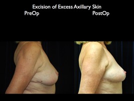BreastLift2012.025.jpg