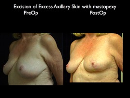 BreastLift2012.026.jpg