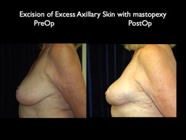 BreastLift2012.027.jpg