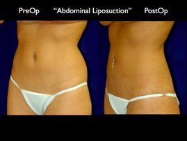 LipoSuction.003.jpg