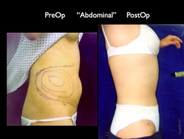 Lipo.006.jpg