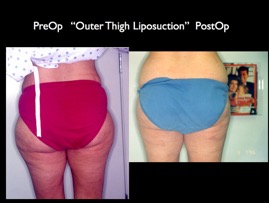 Lipo.009.jpg