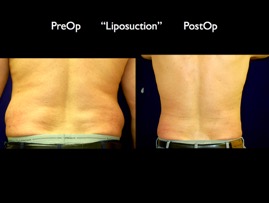 LipoSuction.002.jpg