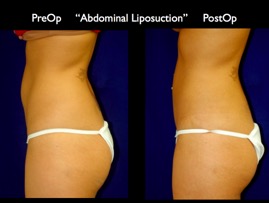 LipoSuction.005.jpg