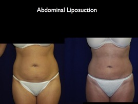 lipo-abd.014.jpg
