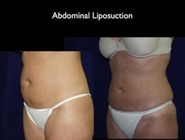 lipo-abd.015.jpg