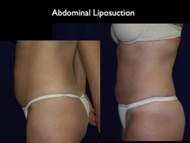 lipo-abd.016.jpg