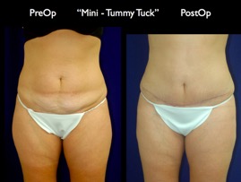TummyTuck.001.jpg