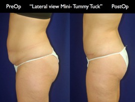 TummyTuck.003.jpg