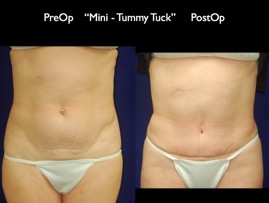 TummyTuck.004.jpg