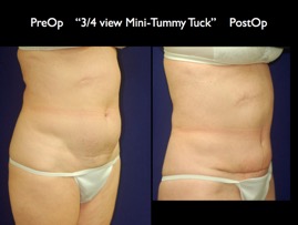 TummyTuck.005.jpg