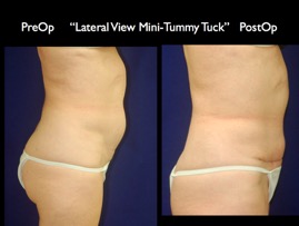TummyTuck.006.jpg