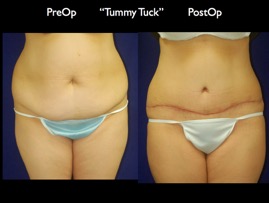 TummyTuck.007.jpg