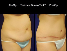 TummyTuck.008.jpg