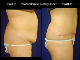 TummyTuck.009.jpg