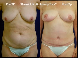 TummyTuck.010.jpg