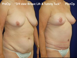 TummyTuck.011.jpg