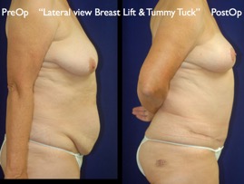 TummyTuck.012.jpg