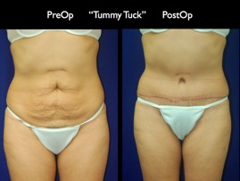 TummyTuck.013.jpg
