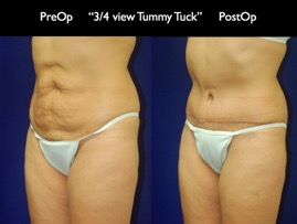 TummyTuck.014.jpg