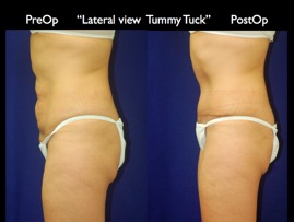 TummyTuck.015.jpg