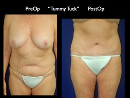 TummyTuck.016.jpg