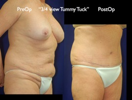 TummyTuck.017.jpg