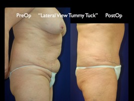 TummyTuck.018.jpg
