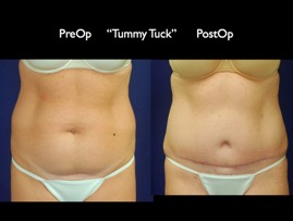 TummyTuck.019.jpg