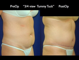 TummyTuck.020.jpg