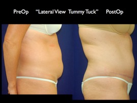 TummyTuck.021.jpg