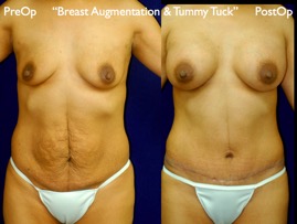 TummyTuck.022.jpg