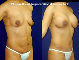 TummyTuck.023.jpg