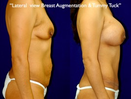 TummyTuck.024.jpg