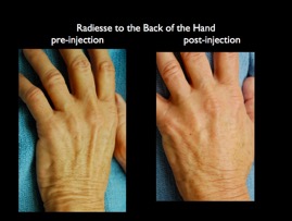 Radiesse hand.001.jpg