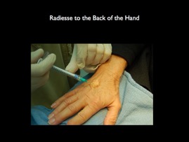 Radiesse hand.002.jpg