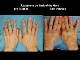 Radiesse hand.003.jpg