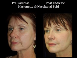Radiess 5/12.011.jpg