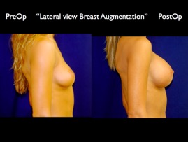 Breast-Aug.003.jpg
