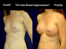 Breast-Aug.014.jpg