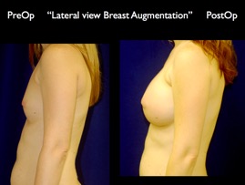 Breast-Aug.015.jpg