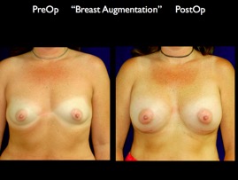 Breast-Aug.016.jpg