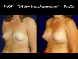 Breast-Aug.017.jpg