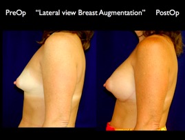 Breast-Aug.018.jpg