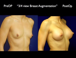 Breast-Aug.020.jpg